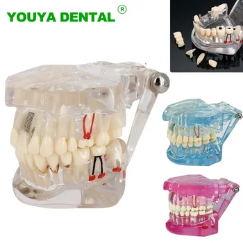 Стоматологическая модель Реставрация имплантатов Модель Мостовидного протеза Съемный зуб Обучение Изучение Медицины Болезни Стоматологические товары