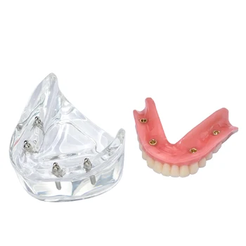 Стоматологическая модель зубов 4 Имплантата, съемный мостовидный протез, нижняя челюсть, модель M6003, лабораторные демонстрационные инструменты
